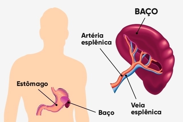 Dor no baço: 4 principais causas e como é o tratamento